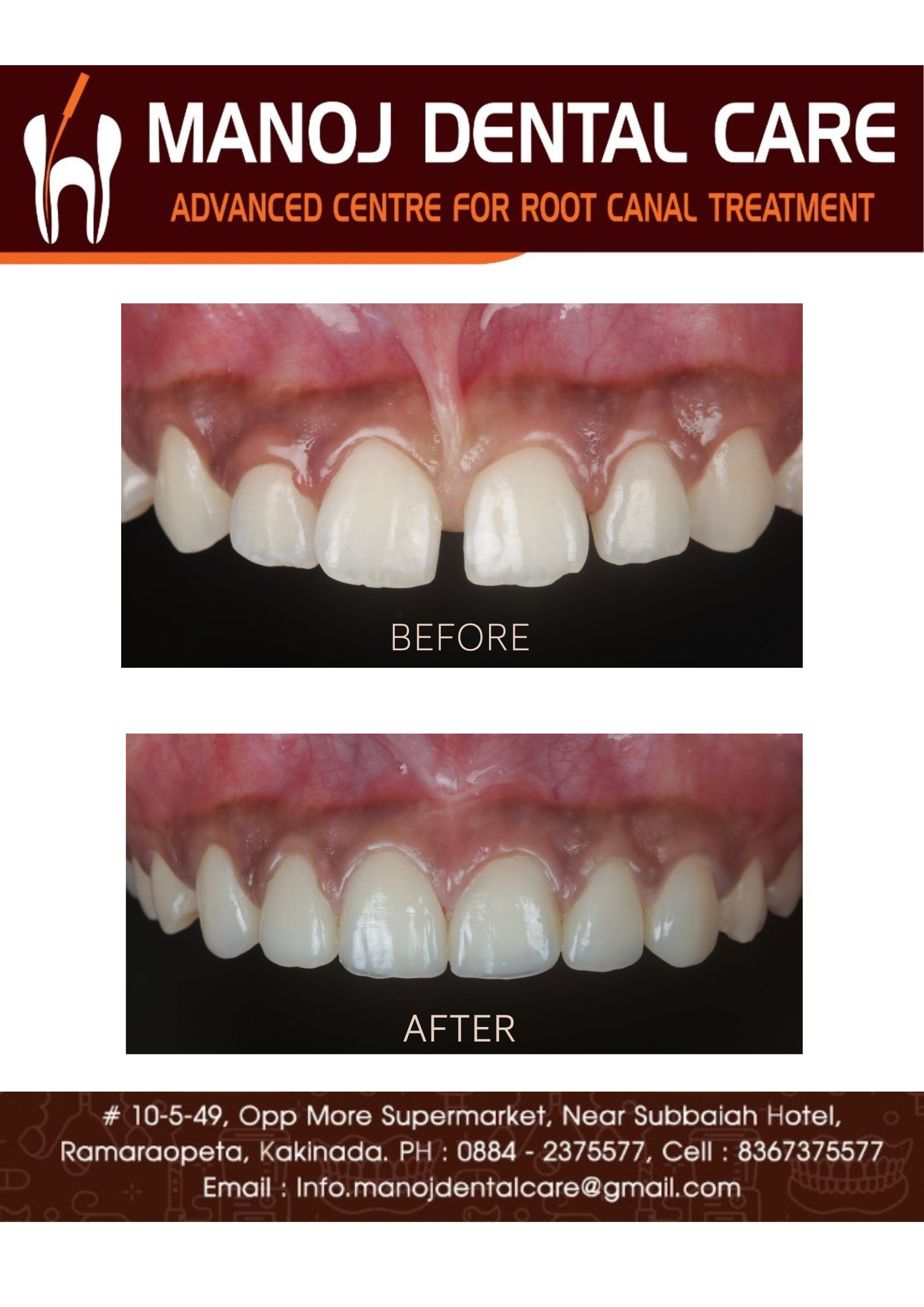 Midline Diastema Closure
